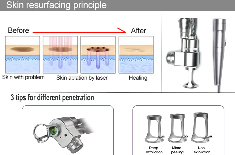 CO2 fractional laser