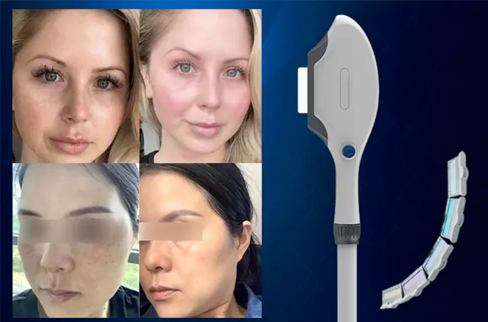 IPL Elight photorejuvenation