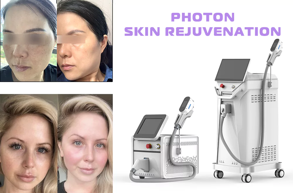 What is the difference between M22 super photon skin rejuvenation and No.1 IPL Elight photon skin rejuvenation?